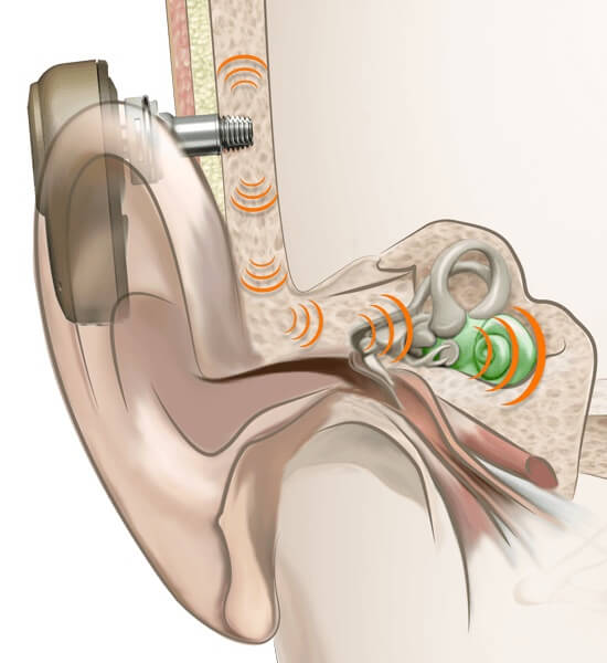 hearing aid, how it works